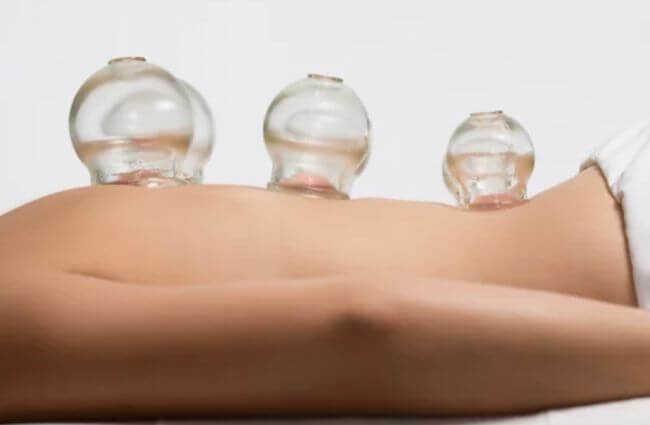 Heilpraxis Wuppertal Leistungen: Schröpfen